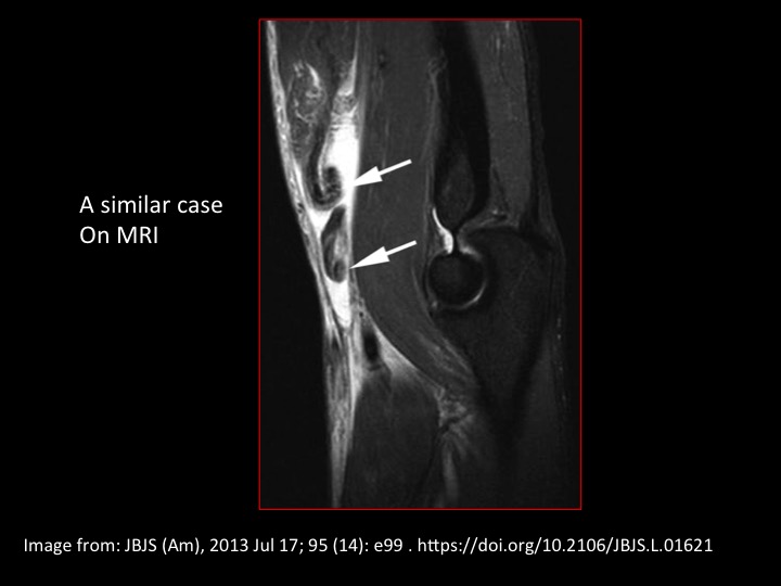 Figure 4 for case distal tendon of biceps brachii ( RID2065 )